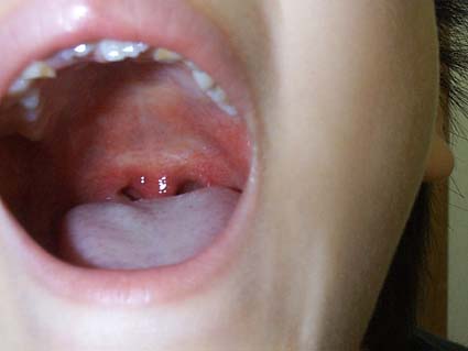 溶連菌以外 いちご舌 ［医師監修・作成］蜂窩織炎はどんな病気？原因、症状、検査、治療など